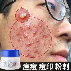 [2 부 5 절] 스두 프린트 여드름 제거 크림 제품 여드름 제거 에센스 알로에 젤 여드름 제거 크림 남녀 청춘 여드름 구덩이 여드름, 단일상품